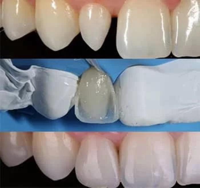 Facettes dentaires en composite
