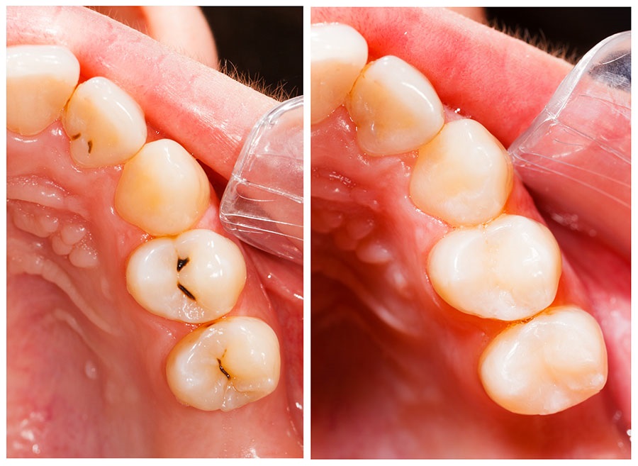 Odontologie conservatrice