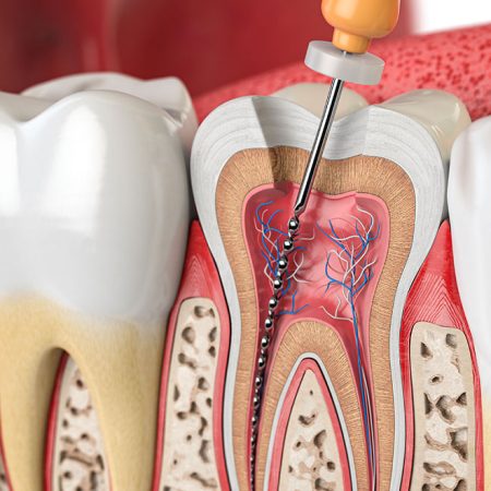 Endodontie traitement de canal