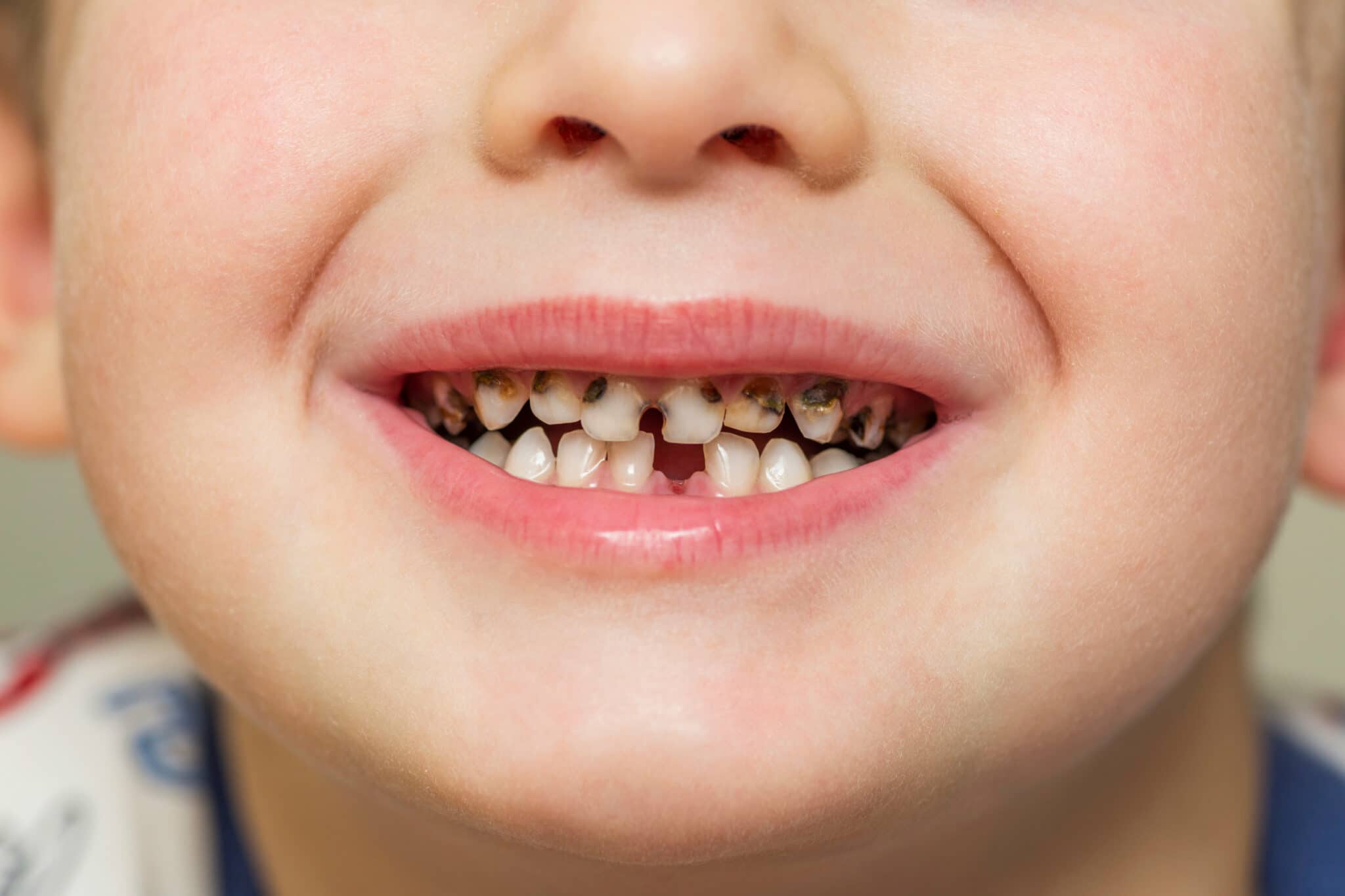 Traitement caries et suivi dentaire enfant